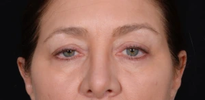 Quad-Blepharoplasty-Case--358 | Before Eyelid Surgery 2