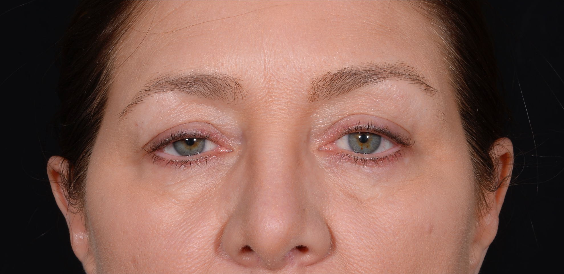 Quad-Blepharoplasty-Case--358 | Before Eyelid Surgery 2