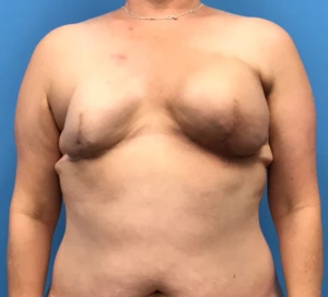 Case--10685 | Before Breast 1