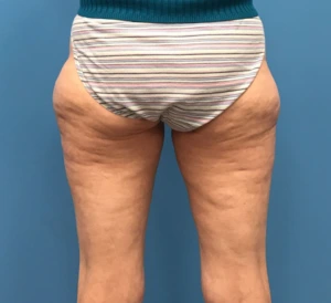 Case--10165 | Before Liposuction 1