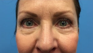 Lower-Blepharoplasty-Case--287 | Before Eyelid Surgery 1