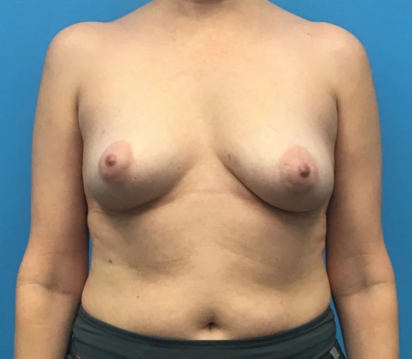 Case--12659 | Before Breast Reconstruction 1
