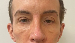 Quad-Blepharoplasty-Case--357 | Before Eyelid Surgery 2