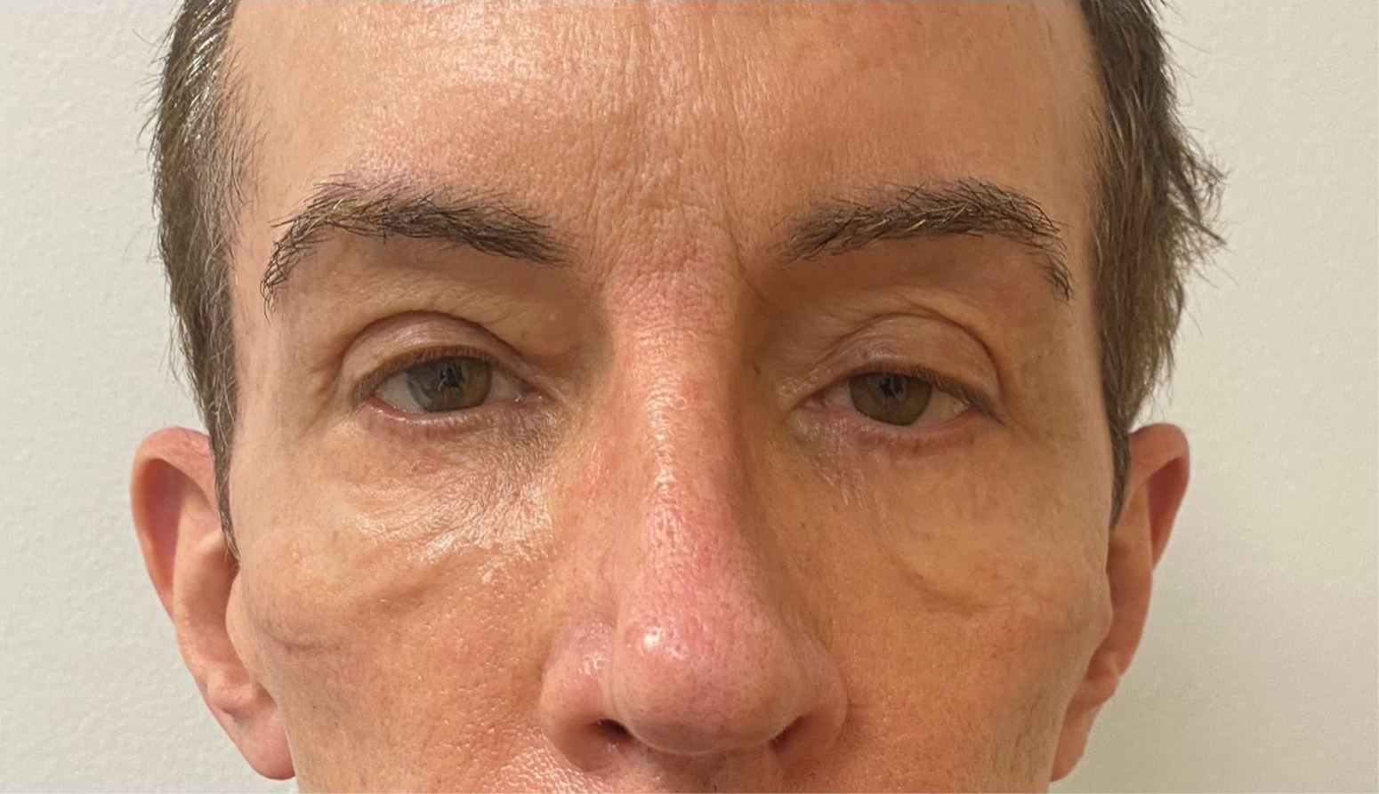 Quad-Blepharoplasty-Case--357 | Before Eyelid Surgery 2