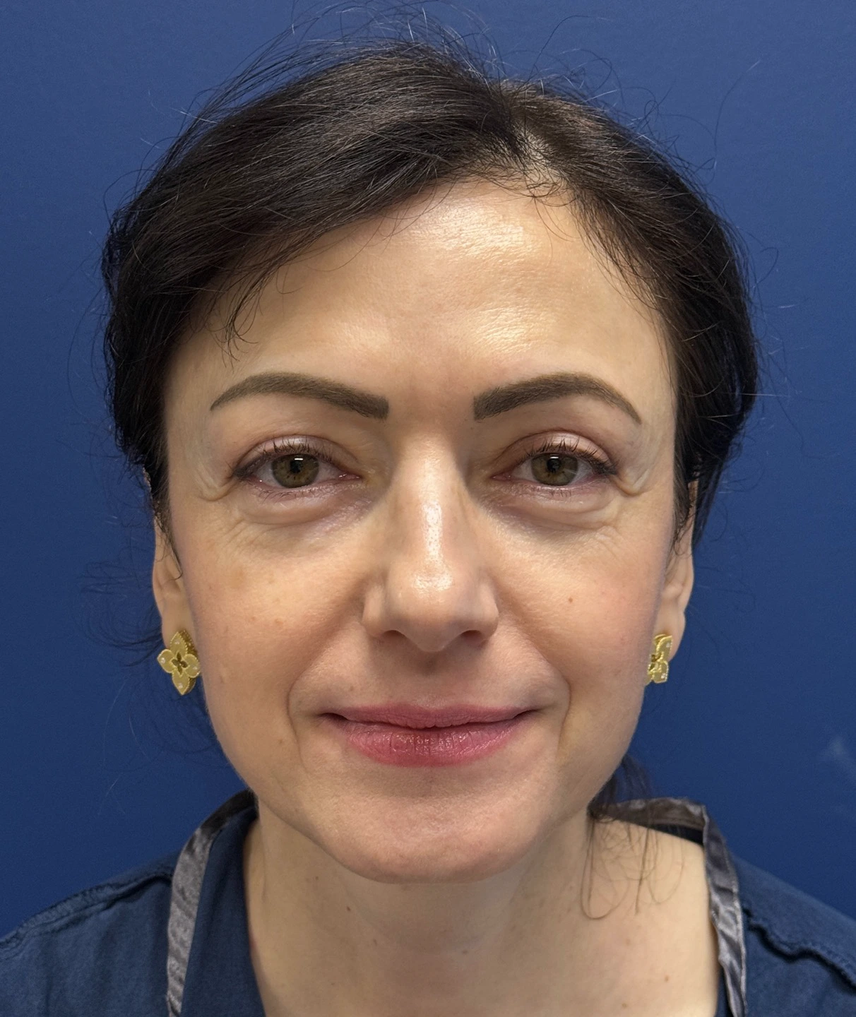 Lower-Blepharoplasty-Case--26939 | Before Eyelid Surgery 1