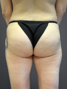 Aveli-Case--6987 | Before Body 1