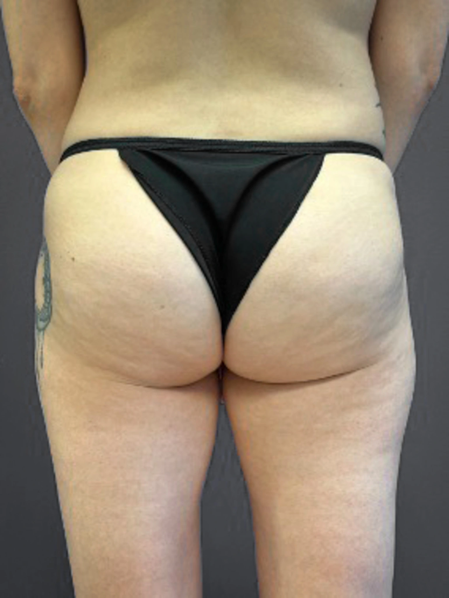 Aveli-Case--6987 | Before Aveli/AlloClae/J-Plasma 1