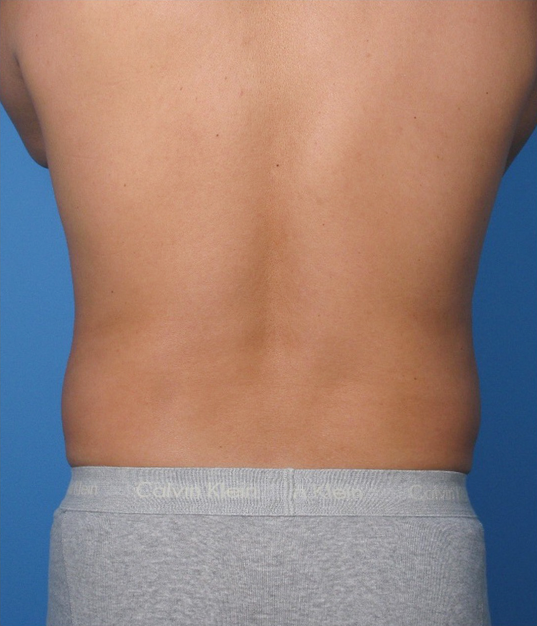 Case--389 | Before Liposuction 3