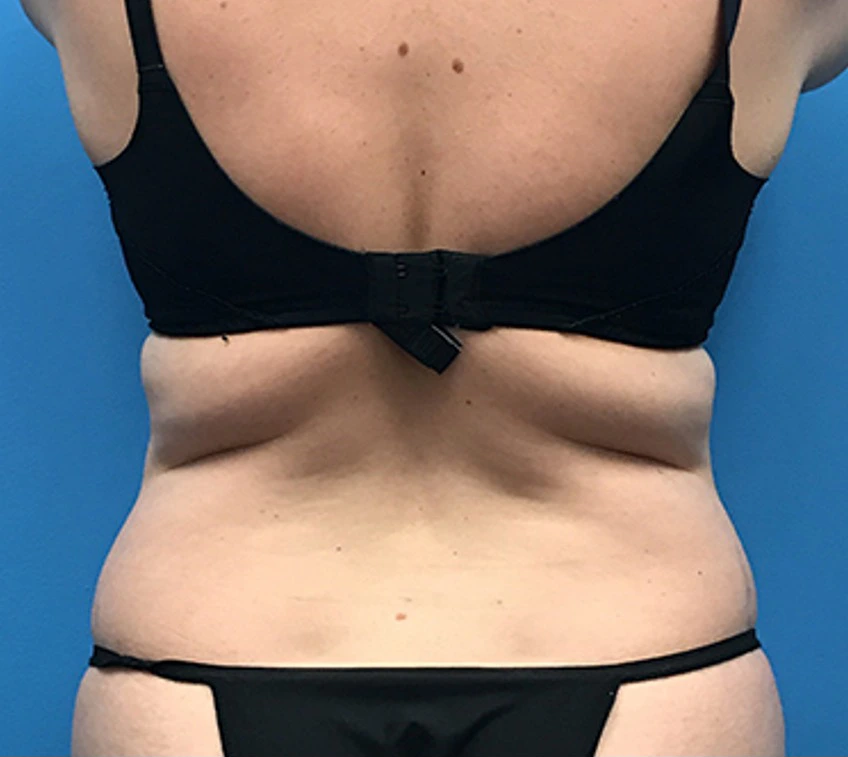 Case--56 | Before Liposuction 4