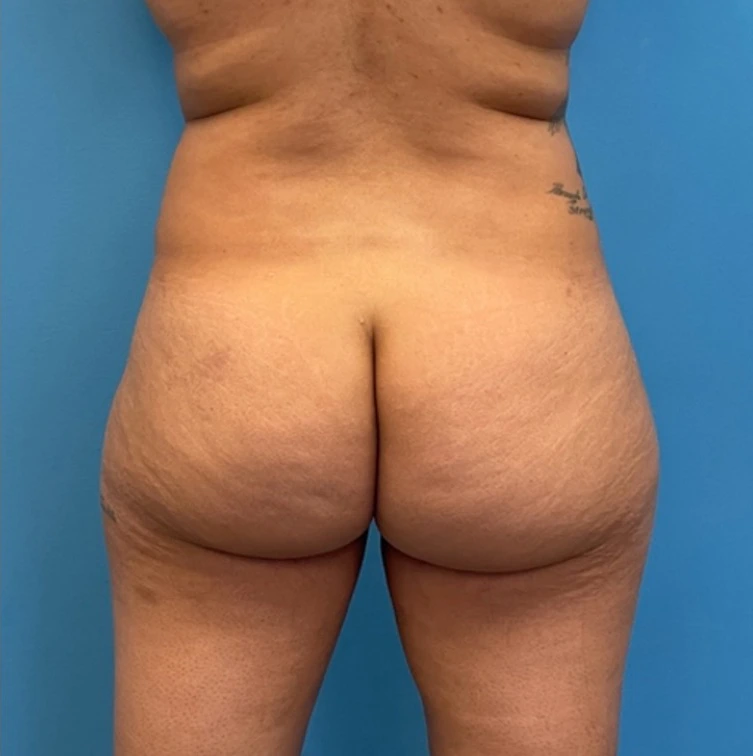 Case--25704 | Before Liposuction 2