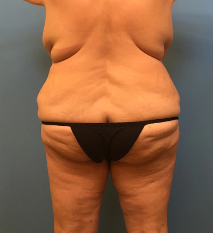 Mommy-Makeover-Case--39 | Before Mommy Makeover 4