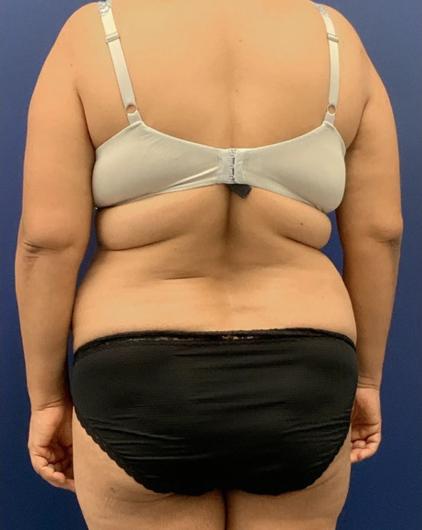 Liposuction-Abdominoplasty-Case--25576 | Before Liposuction 6