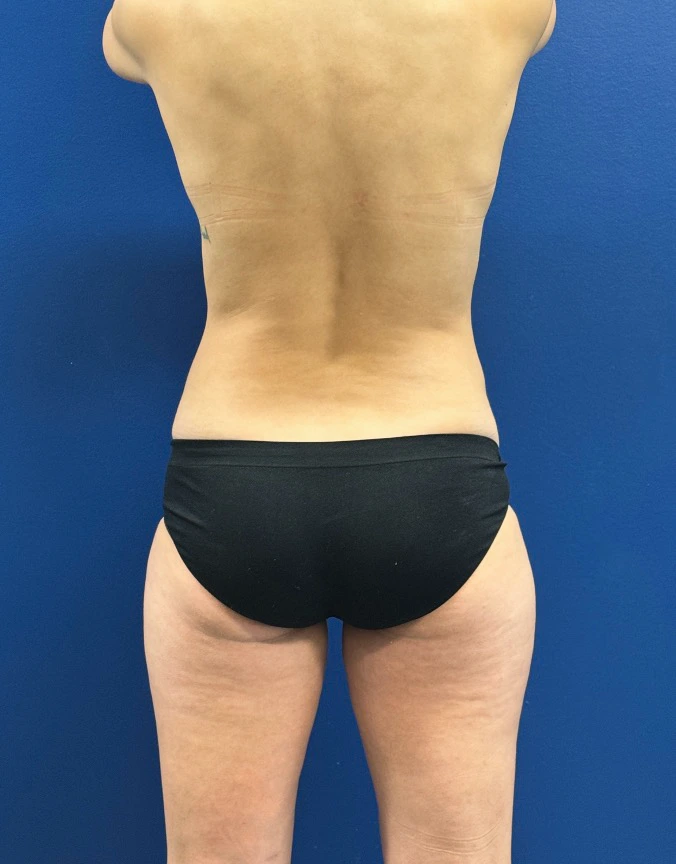 Breast-Augmentation-Tummy-Tuck-Case--29010 | Before Breast Augmentation With Lift 5