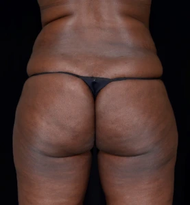 Brazilian-Butt-Lift-Case--353 | Before Brazilian Butt Lift 1