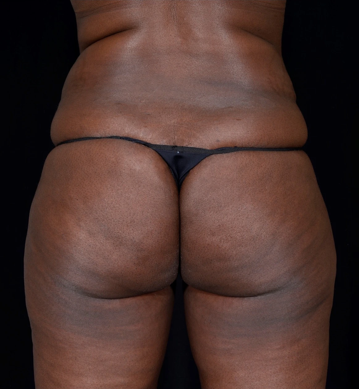 Brazilian-Butt-Lift-Case--353 | Before Brazilian Butt Lift 1