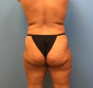 Case--247 | Before Liposuction 2