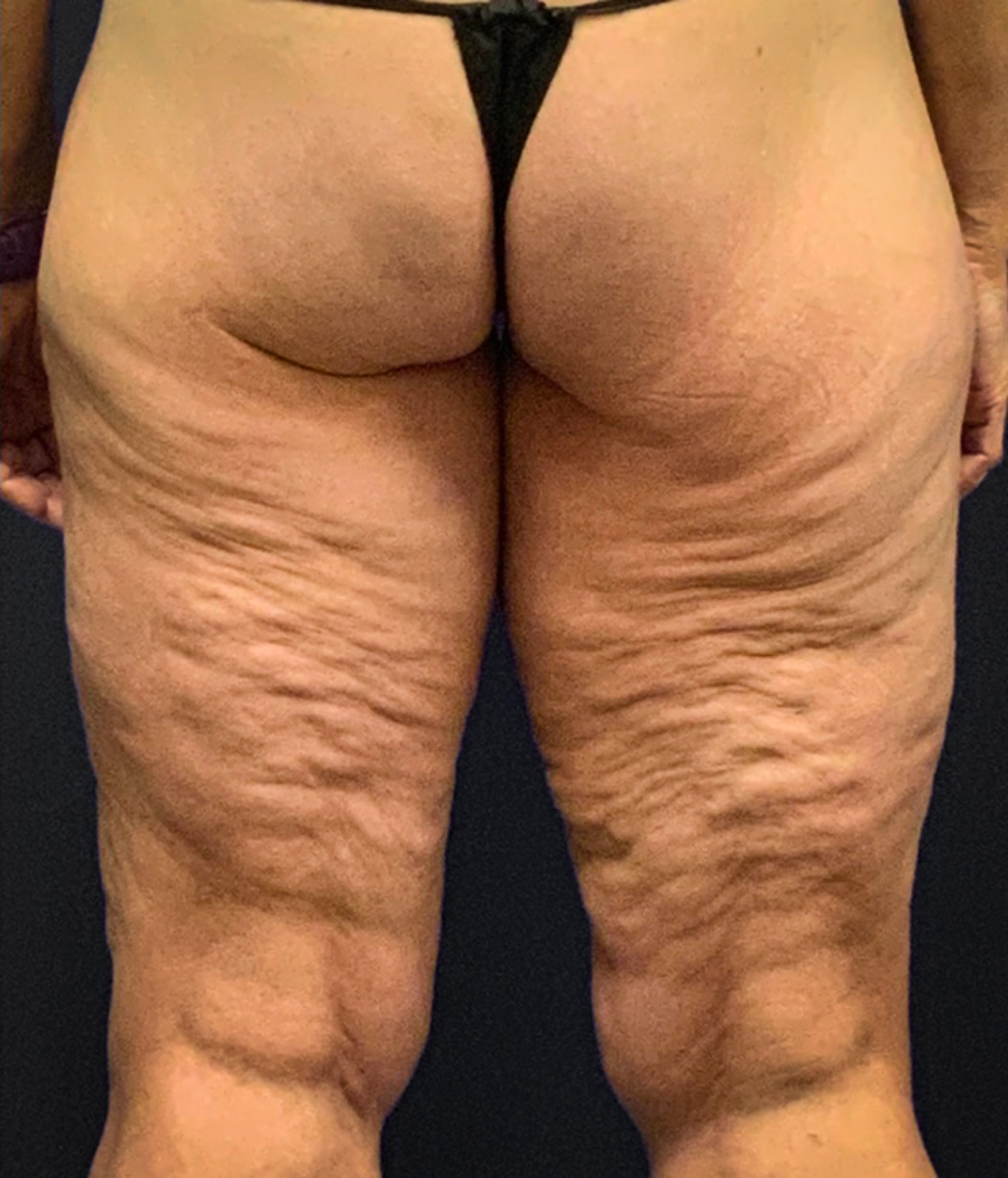 Thighplasty-Case--2024 | Before Thigh Lift 4