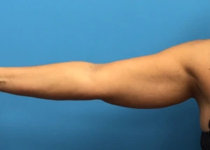 Case--280 | Before Liposuction 1