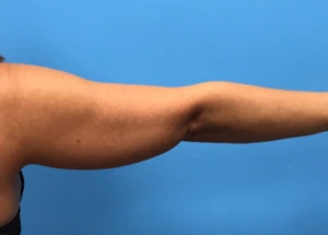 Case--280 | Before Liposuction 2