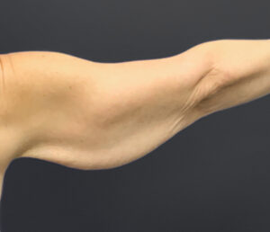 Brachioplasty-Case--6382 | Before Arm Lift 1