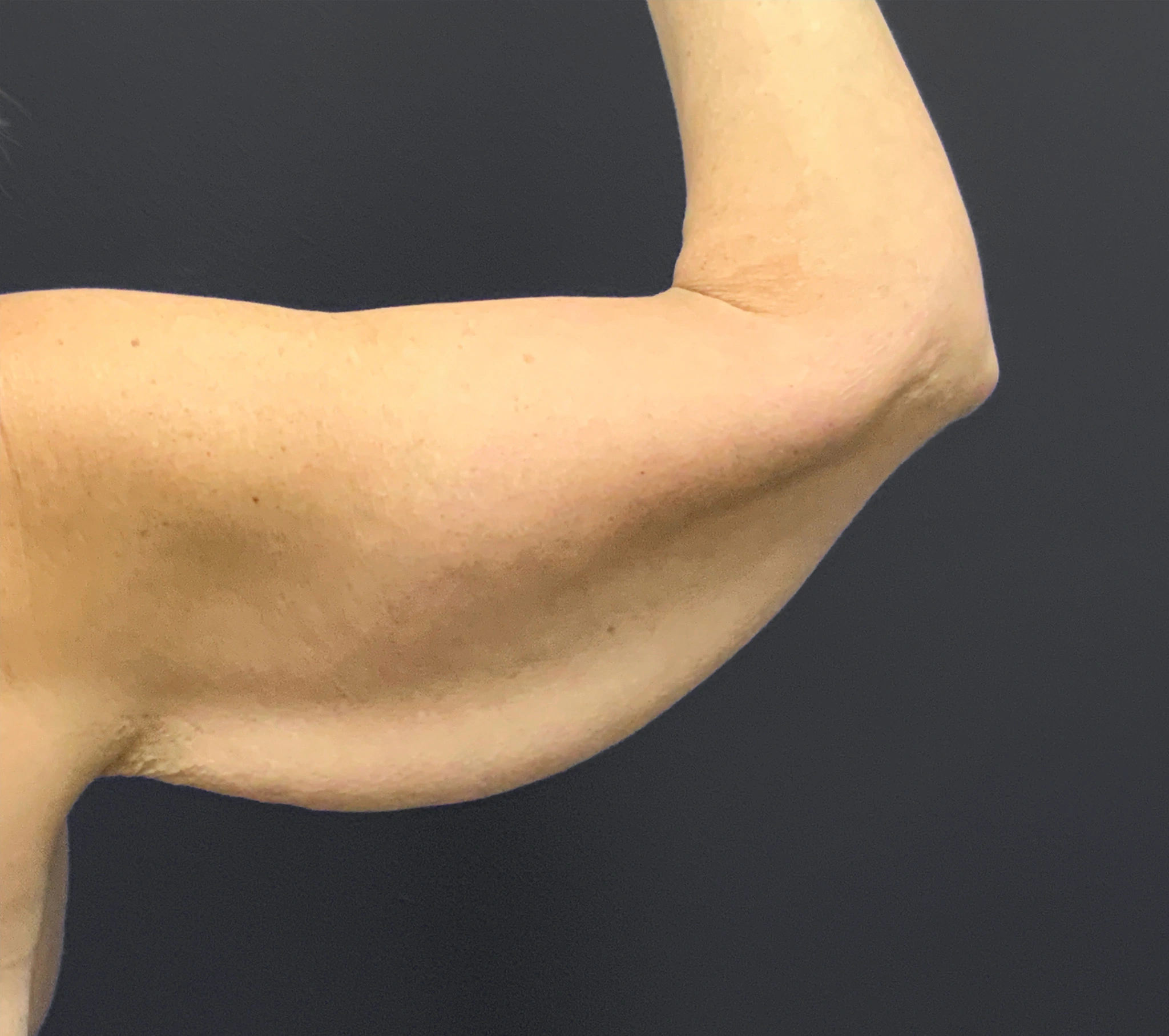 Brachioplasty-Case--6382 | Before Arm Lift 3