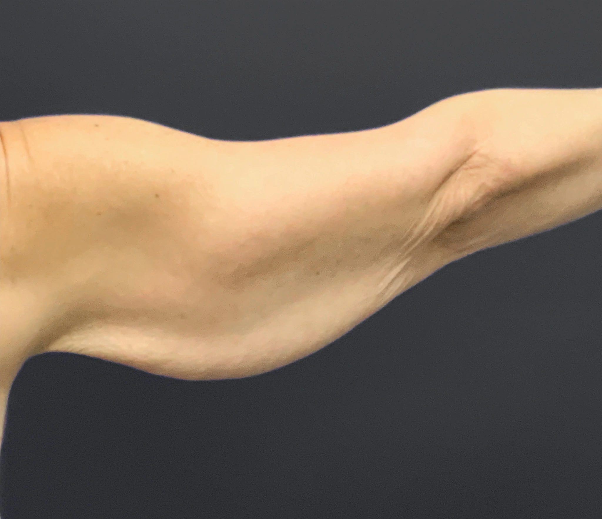 Brachioplasty-Case--6382 | Before Arm Lift 1