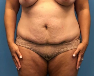 Case--252 | Before Mommy Makeover 1