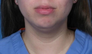 Case--293 | Before Submental Liposuction 1