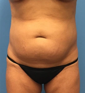 Case--65 | Before Liposuction 1