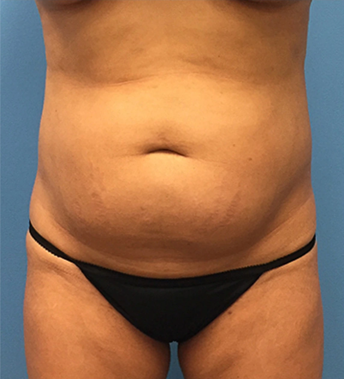 Case--65 | Before Liposuction 1