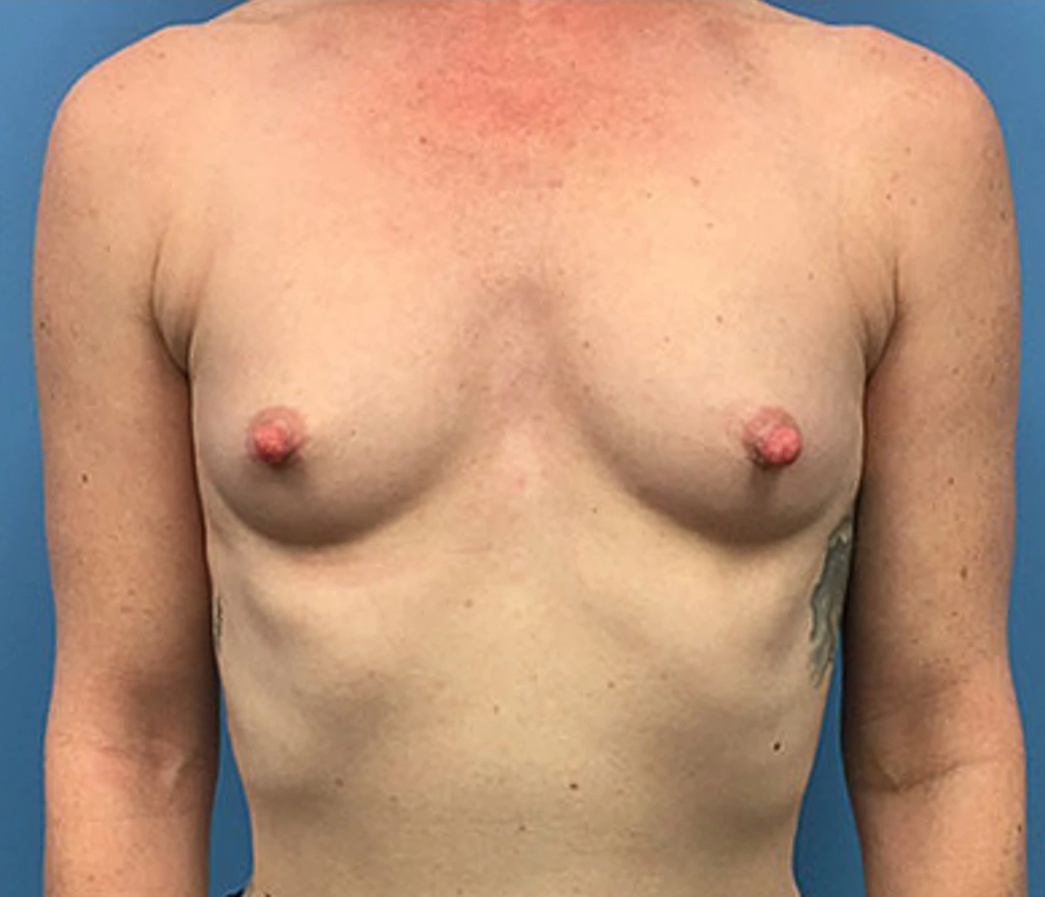 Case--88 | Before Breast Augmentation 1
