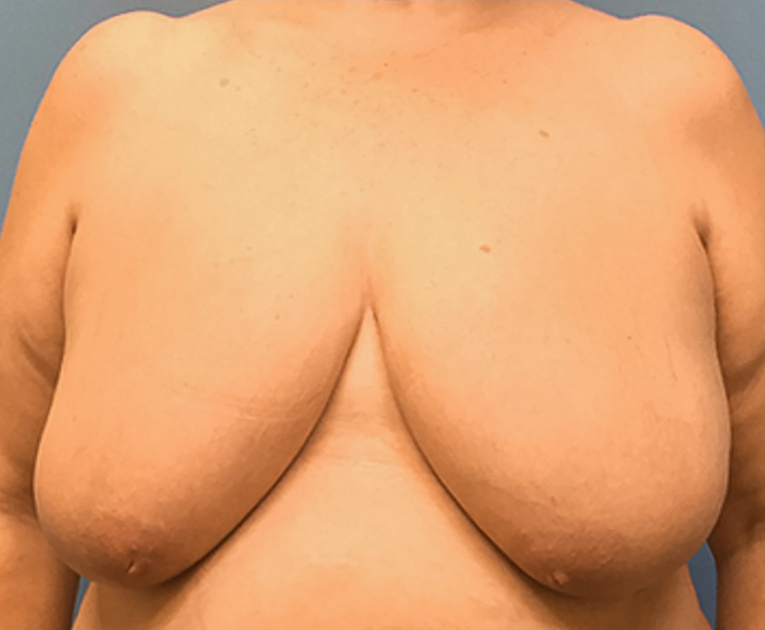 Breast-Reduction-Case--130 | Before Breast Reduction 1