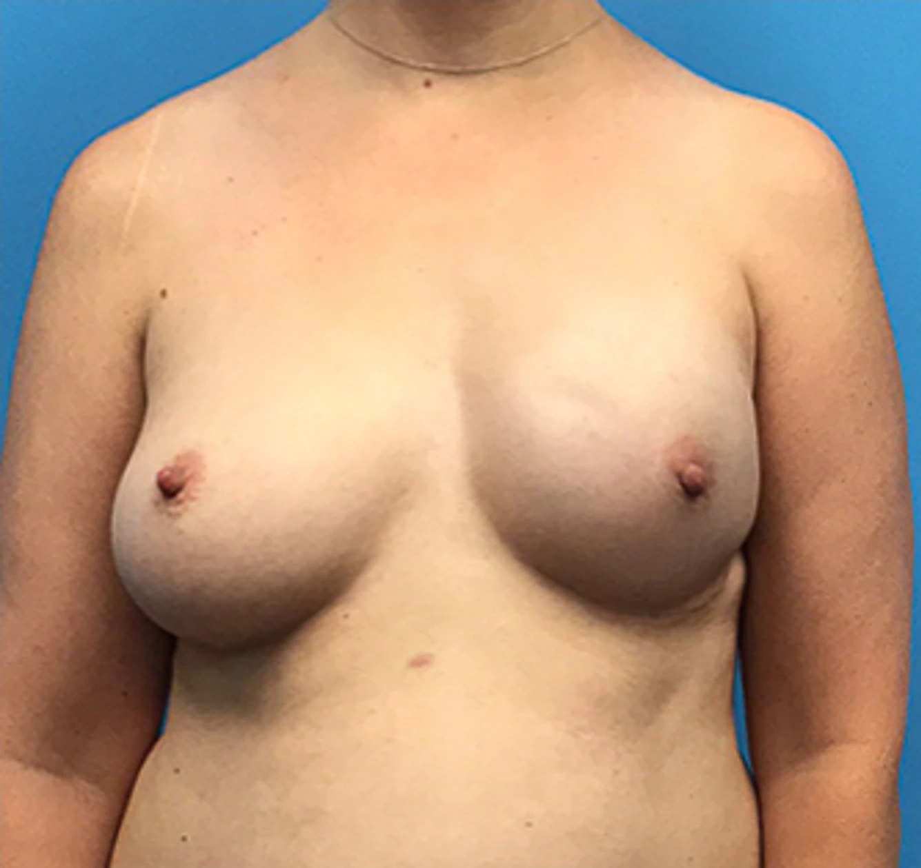Case--136 | Before Breast Reconstruction 1