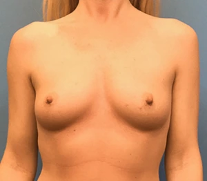 Case--140 | Before Breast 1