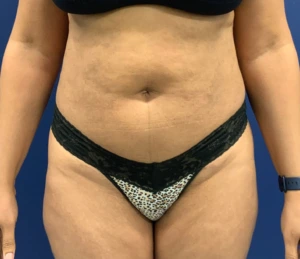 Lipoabdominoplasty-Case--21755 | Before Tummy Tuck 1