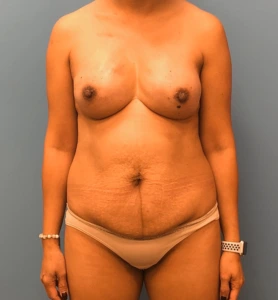 Case--11542 | Before Tummy Tuck 1