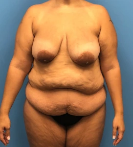 Lipoabdominoplasty-Breast-Augmentation-Case--15133 | Before Mommy Makeover 1