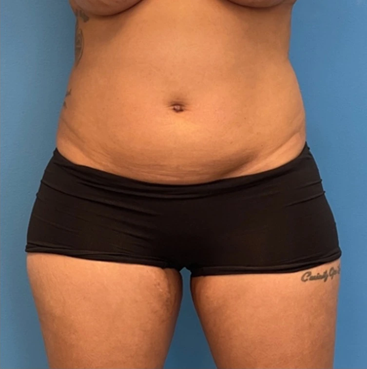 Case--25704 | Before Liposuction 1