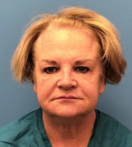 Facelift-Case--14460 | Before Dr. Samir Rao 1