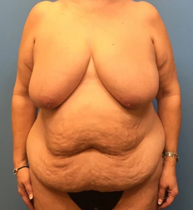 Mommy-Makeover-Case--39 | Before Mommy Makeover 1