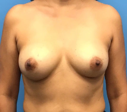Case--134 | Before Breast Reconstruction 1