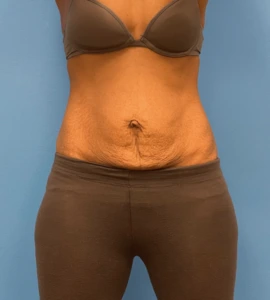 Abdominoplasty-Case--24922 | Before Liposuction 1