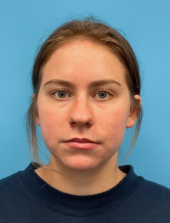 Rhinoplasty-Septoplasty-Case--23611 | Before Rhinoplasty 3