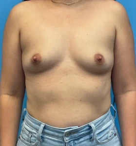 Breast-Augmentation-Case--25743 | Before Dr. Arjun Kanuri 1