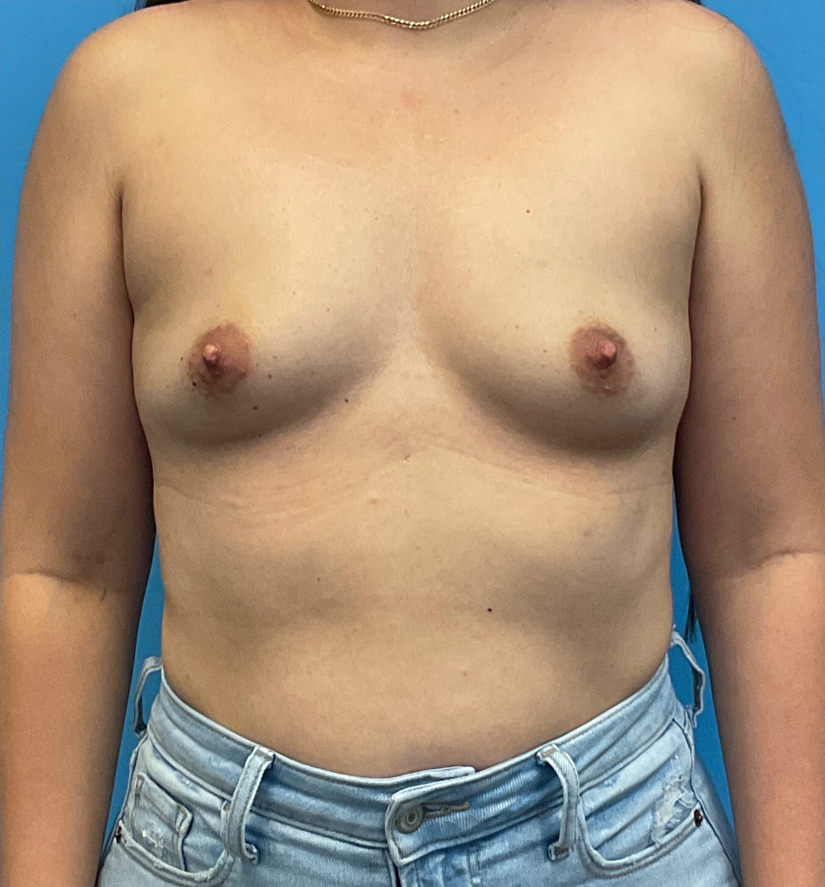 Breast-Augmentation-Case--25743 | Before Breast Augmentation 1