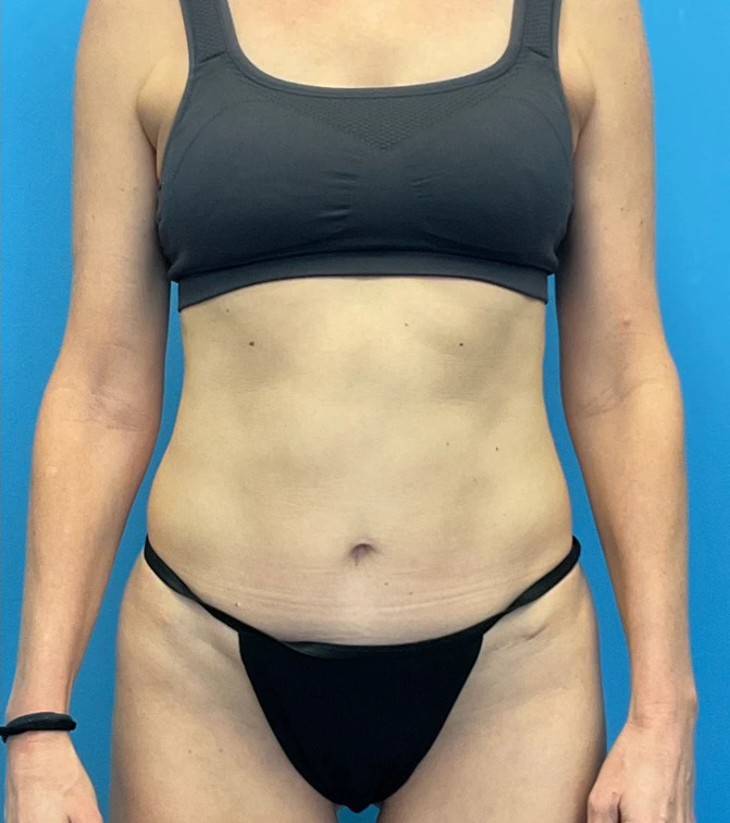 Revision-Tummy-Tuck-Case--23643 | Before Tummy Tuck 1