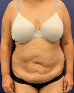 Liposuction-Abdominoplasty-Case--25576 | Before Liposuction 1