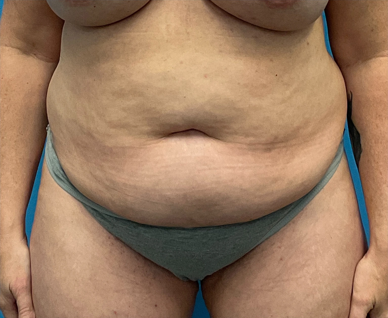 Liposuction-Tummy-Tuck-Case--25682-2 | Before Liposuction 1