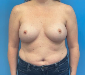 Breast-Reconstruction-Case--27065 | Before Breast Reconstruction 1