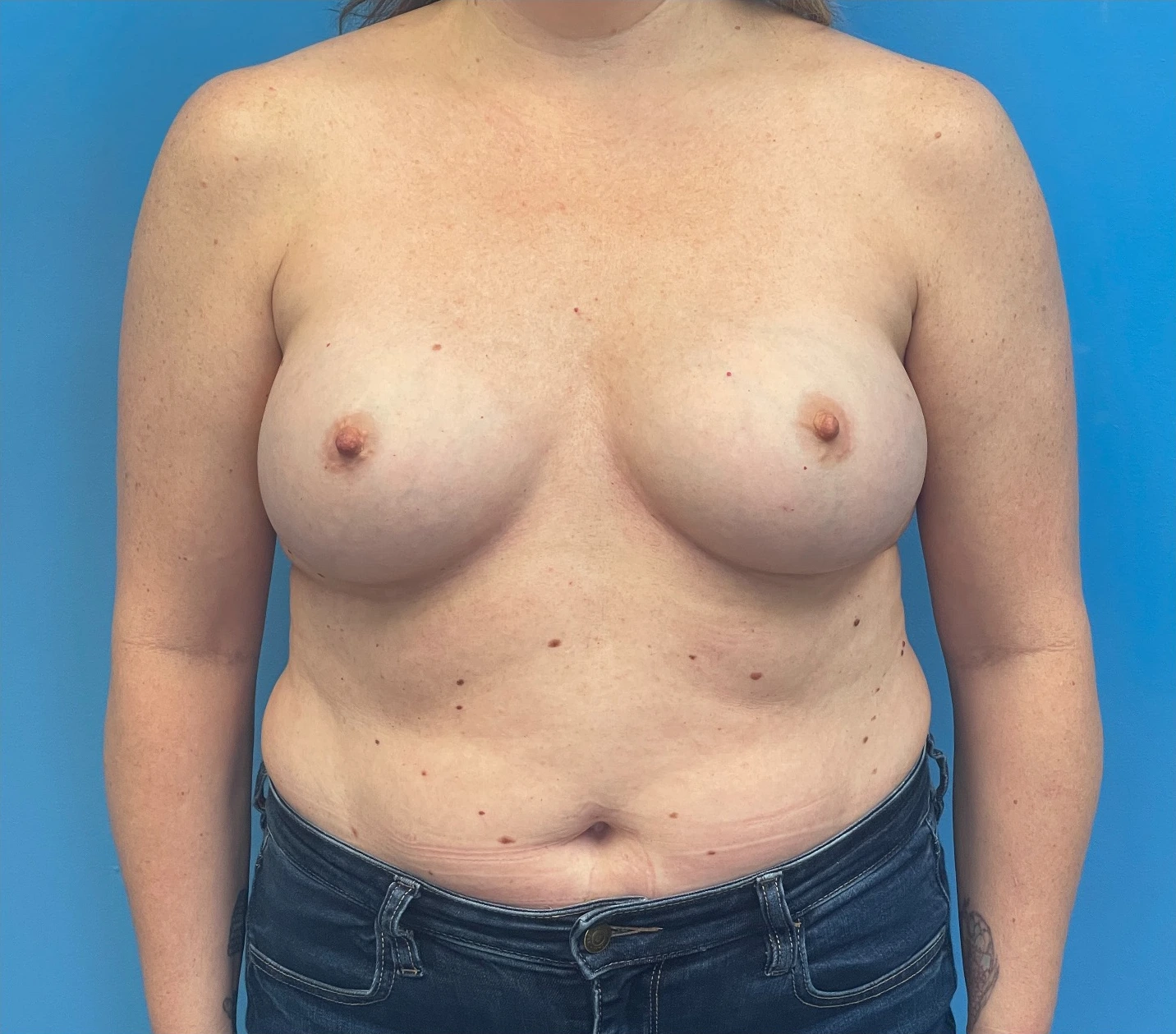 Breast-Reconstruction-Case--27065 | Before Breast Reconstruction 1